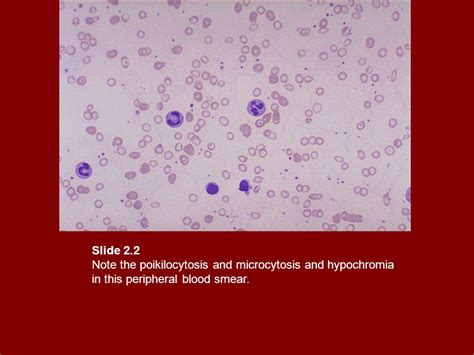 2.1: Poikilocytosis .